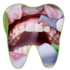 Teeth Cleaning