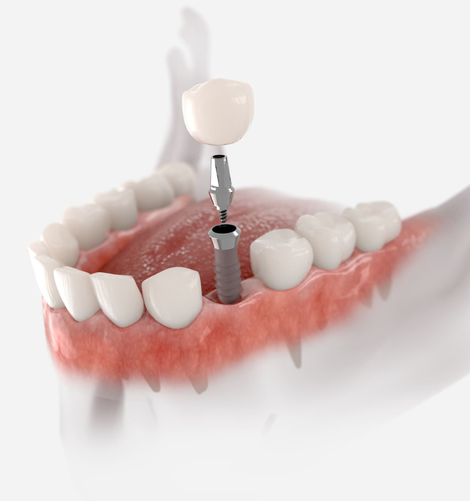 best dental implants in abu dhabi