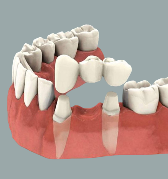 dental-crowns-bridges