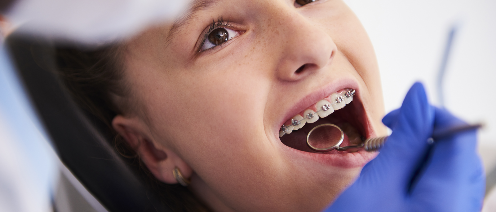 Braces in Abu Dhabi – Transform Your Smile with First Dent Dental Center