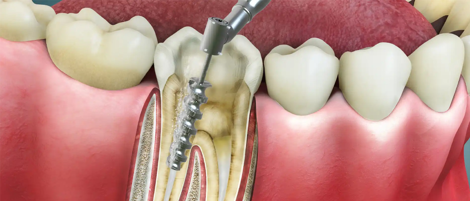 Root Canal Treatment at First Dent Dental Center: Save Your Smile Today