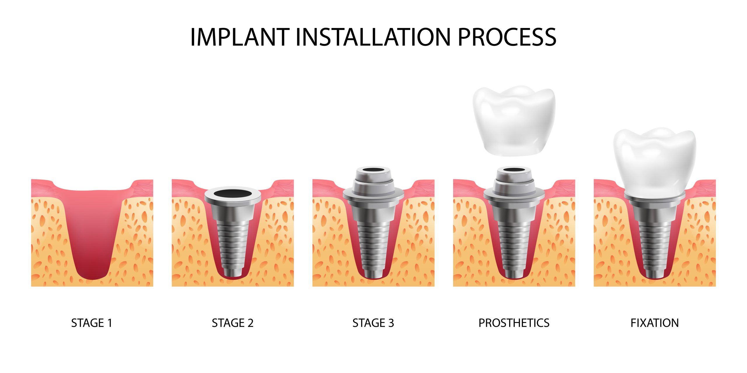 Dental Implants Abu Dhabi – Permanent Solution for Missing Teeth